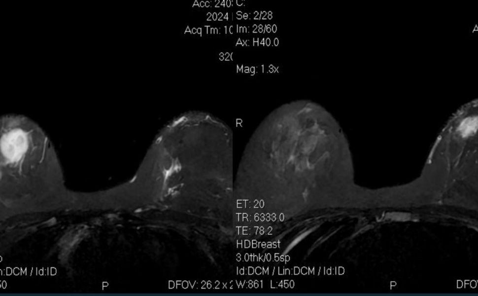 breast mri case vietwellness tour